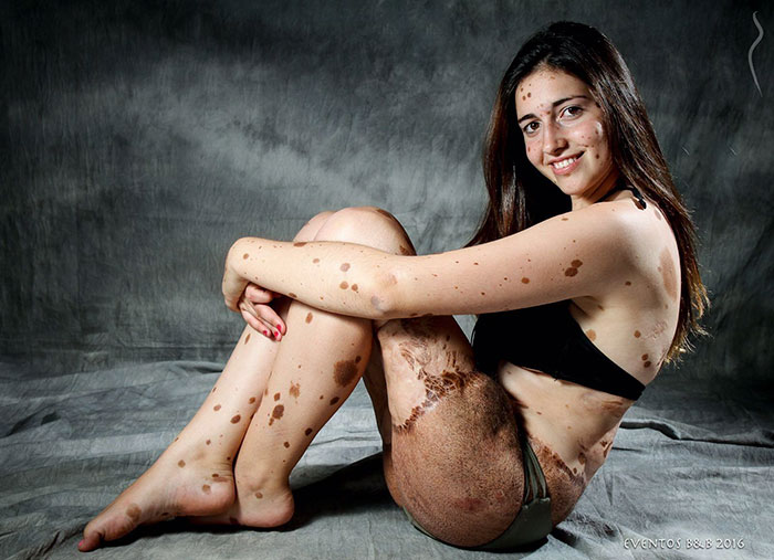 Cette adolescente avec 500 taches de naissance a été brutalement intimidée, mais regardez-la maintenant