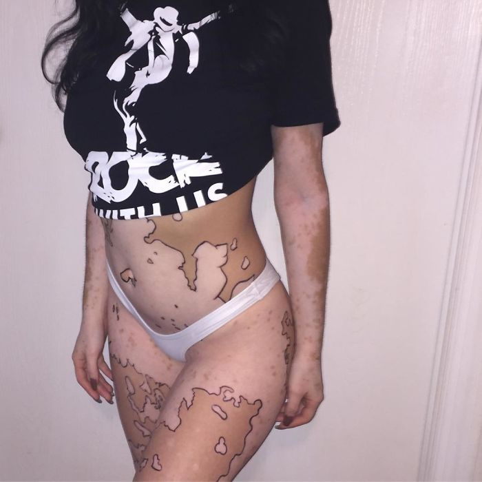 Ridiculisée toute sa vie à cause du vitiligo, elle décide de transformer son corps en oeuvres d’art