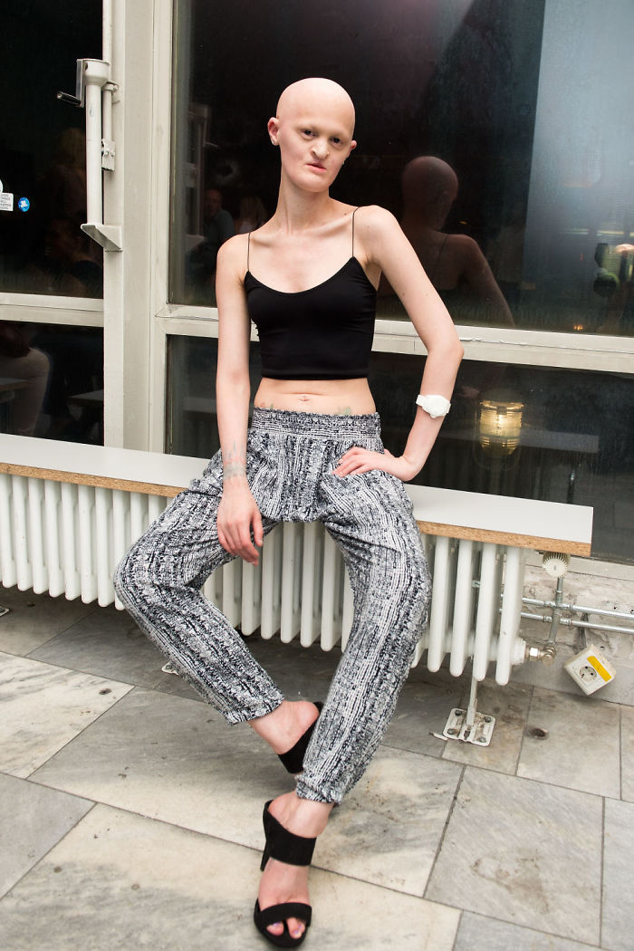Cette mannequin de 28 ans atteinte d’une rare maladie génétique fracasse les stéréotypes de la mode