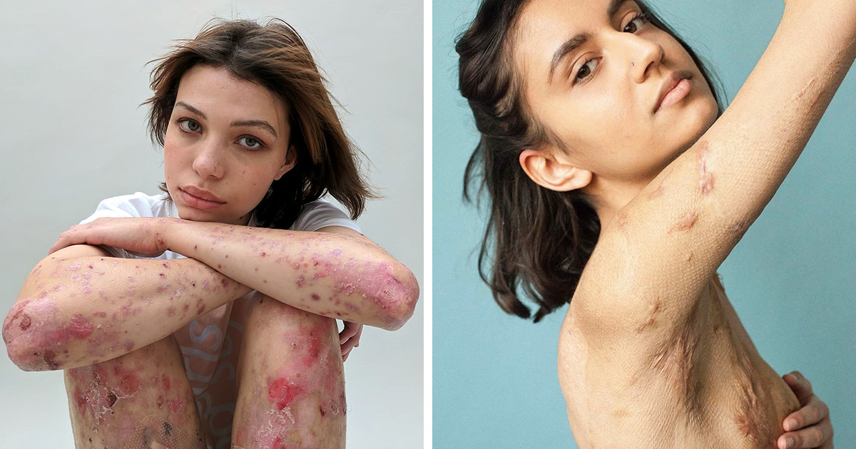 Des gens révèlent leurs cicatrices et comment ils les ont eues dans une puissante série de photos