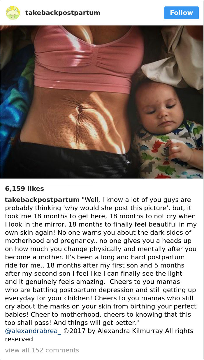 28 photos honnêtes de corps post-accouchement que les femmes partagent pour révéler la vérité dont personne ne parle