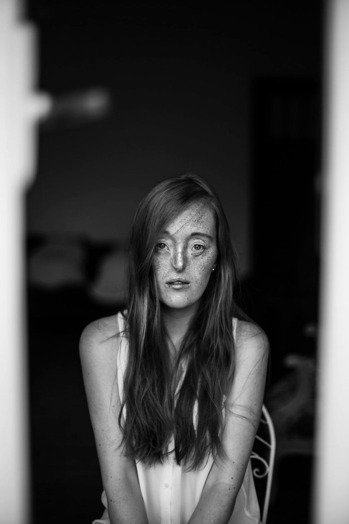 Cette femme de 26 ans est née avec une rare dysmorphie faciale et elle ...
