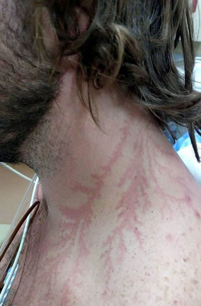 19 personnes qui ont survécu à un coup de foudre montrent ce que ça fait à la peau