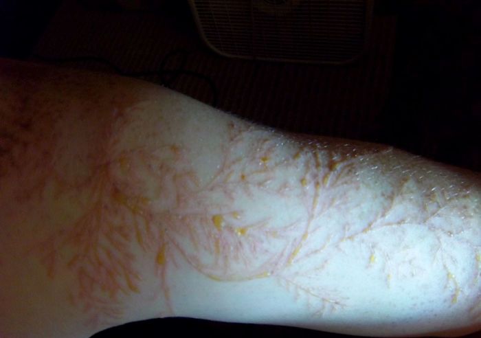 19 personnes qui ont survécu à un coup de foudre montrent ce que ça fait à la peau