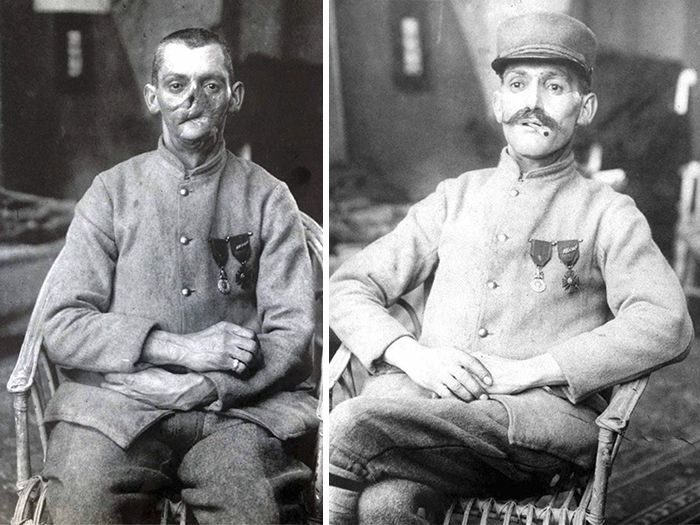 Ces photos fascinantes avant et après montrent comment cette femme a changé la vie d’anciens combattants de la Première Guerre mondiale en «&nbsp;restaurant&nbsp;» leurs visages