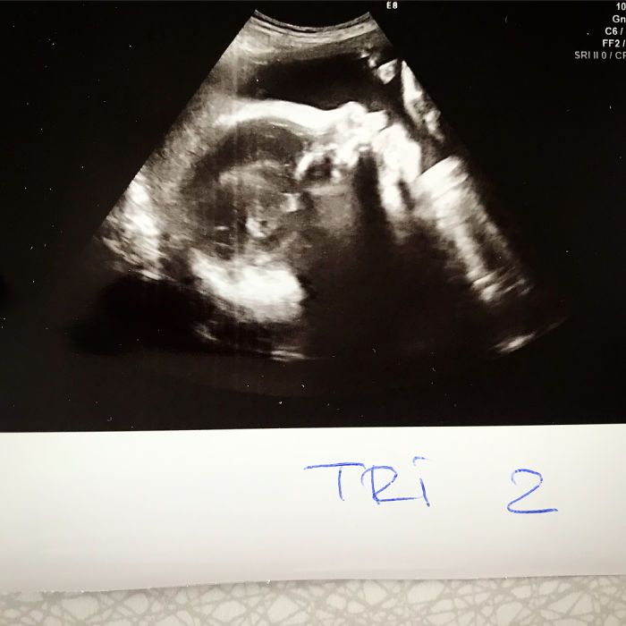 Voici ce que 3 bébés qui grandissent dans le même ventre font à votre corps