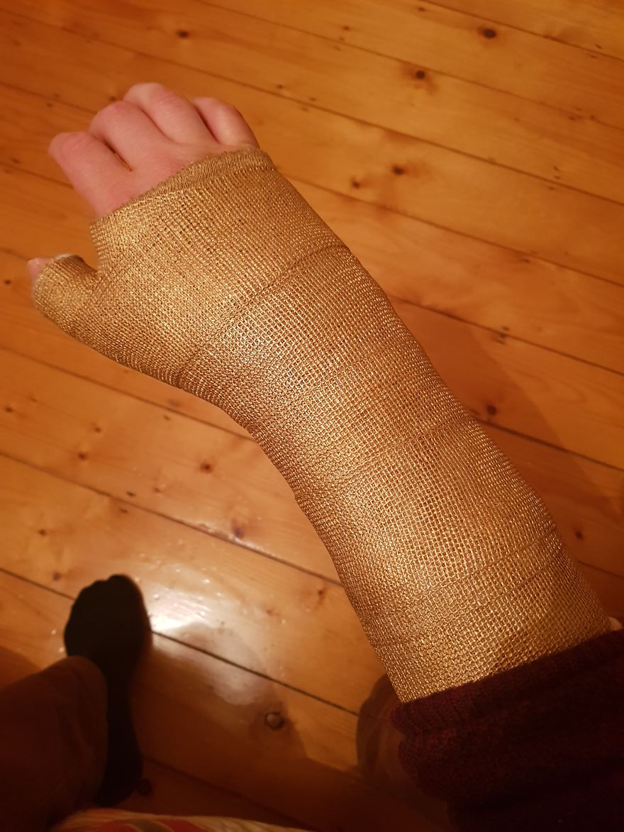 Après m’être cassé le poignet, j’ai transformé mon plâtre en « Gant de l’Infini » de Thanos