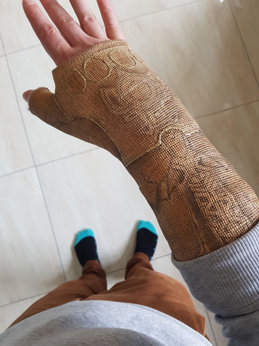 Après m’être cassé le poignet, j’ai transformé mon plâtre en « Gant de l’Infini » de Thanos