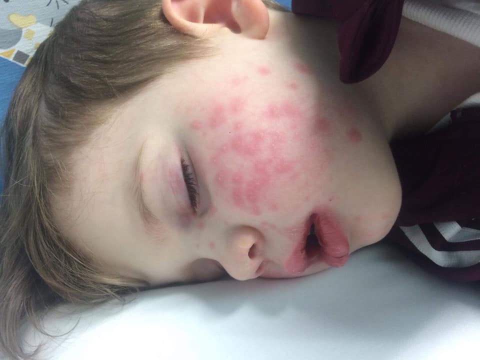 Cet enfant en bas âge a été « presque aveuglé » après avoir attrapé l’herpès lorsqu’il a été embrassé par un membre de sa famille