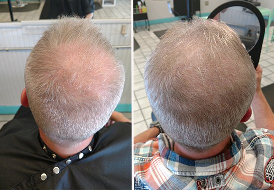 Cet homme prétend que boire son pipi a fait repousser ses cheveux