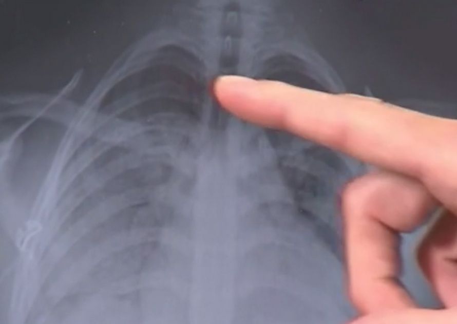 Un adolescent atteint d’une maladie liée au vapotage dit qu’il a maintenant les poumons d’un homme de 70 ans