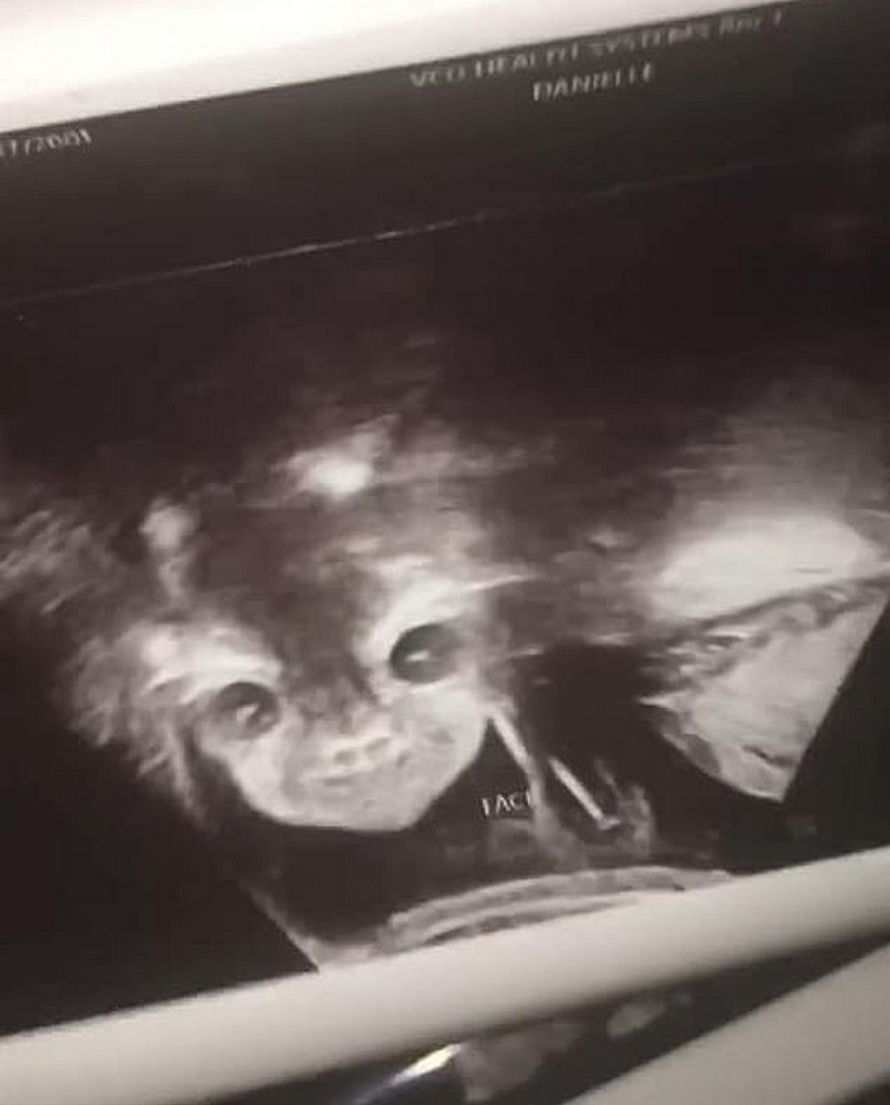 L’échographie terrifiante de cette femme montre un « bébé démoniaque » qui regarde droit dans son âme