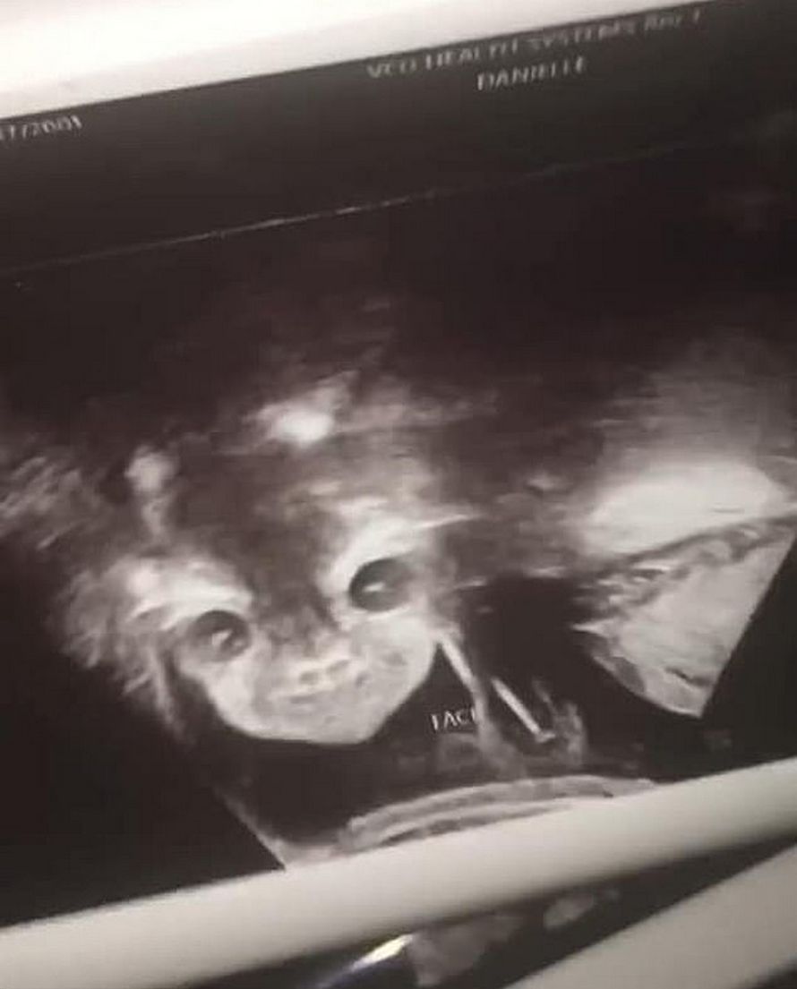 L Echographie Terrifiante De Cette Femme Montre Un Bebe Demoniaque Qui Regarde Droit Dans Son Ame Ipnoze L Echographie Terrifiante De Cette Femme Montre Un Bebe Demoniaque Qui Regarde Droit Dans Son Ame Ipnoze