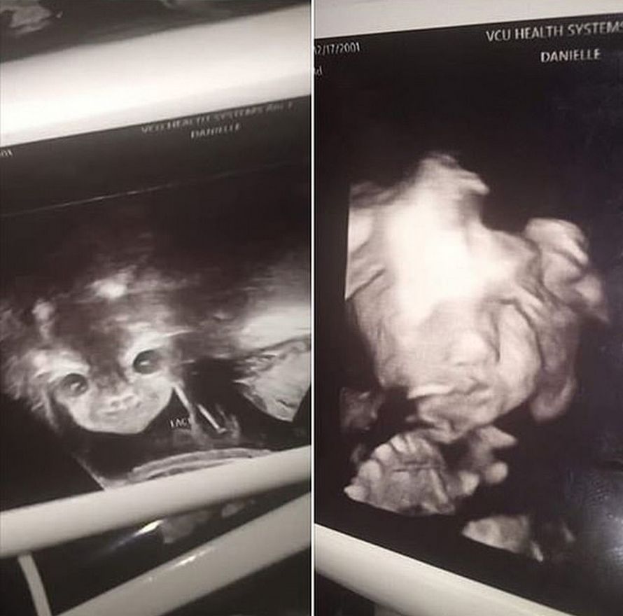 L’échographie terrifiante de cette femme montre un « bébé démoniaque » qui regarde droit dans son âme
