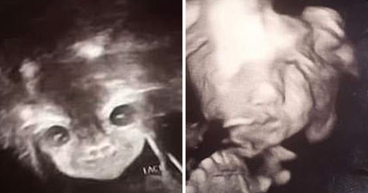 L Echographie Terrifiante De Cette Femme Montre Un Bebe Demoniaque Qui Regarde Droit Dans Son Ame Ipnoze