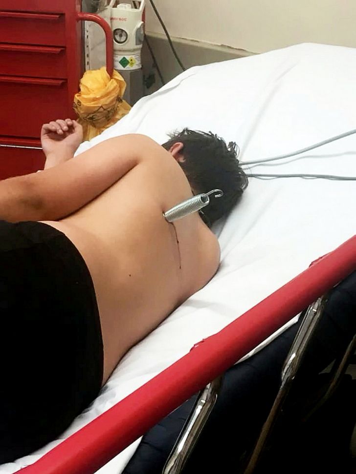 Ce garçon s’est retrouvé avec un ressort de 15 cm incrusté dans le dos après un accident de trampoline