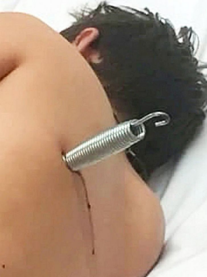 Ce garçon s’est retrouvé avec un ressort de 15 cm incrusté dans le dos après un accident de trampoline
