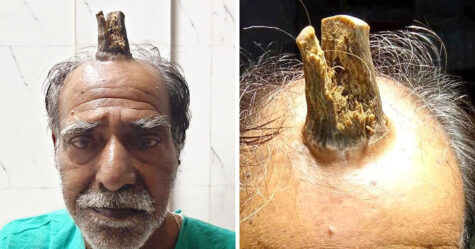 Cet homme a été horrifié lorsqu’une « corne du diable » de 10 cm lui a poussé sur la tête