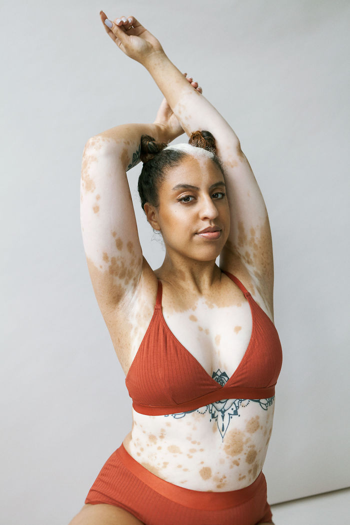 33 jolies femmes atteintes de vitiligo capturées par une photographe souffrant de la même maladie