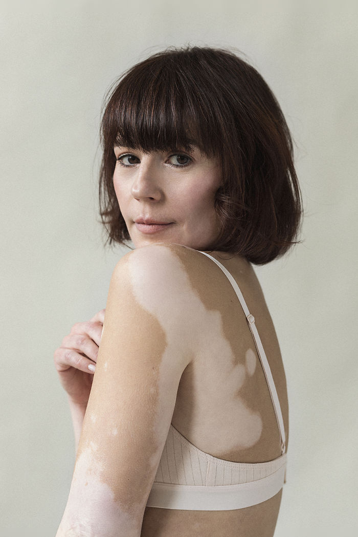 33 jolies femmes atteintes de vitiligo capturées par une photographe souffrant de la même maladie