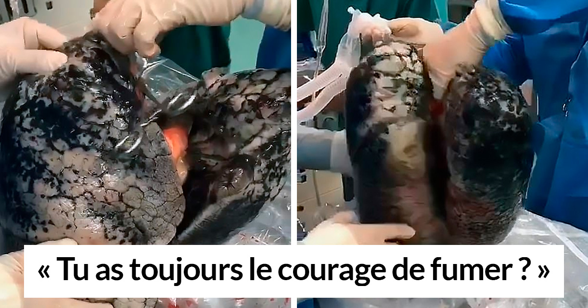 C Est Quoi Un Pied Noir Des chirurgiens montrent Ă quoi ressemblent des poumons aprĂšs 30 ans de