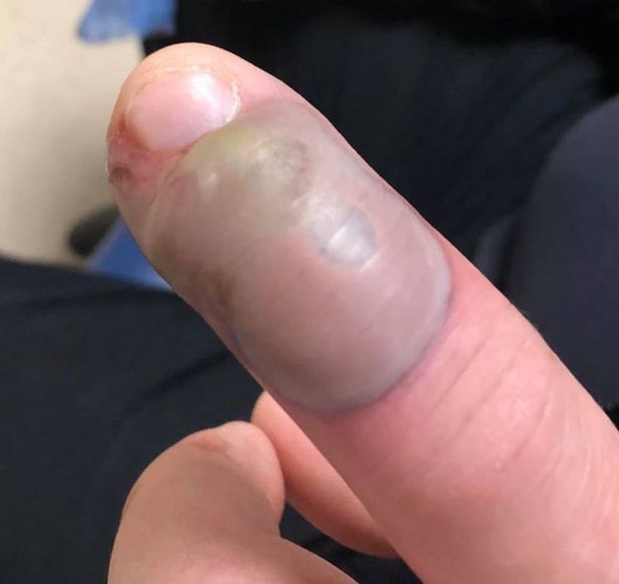 Un homme a contracté une infection mortelle après s’être rongé les ongles