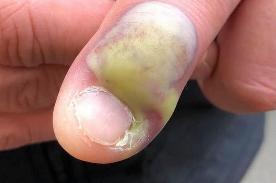 Un homme a contracté une infection mortelle après s’être rongé les ongles