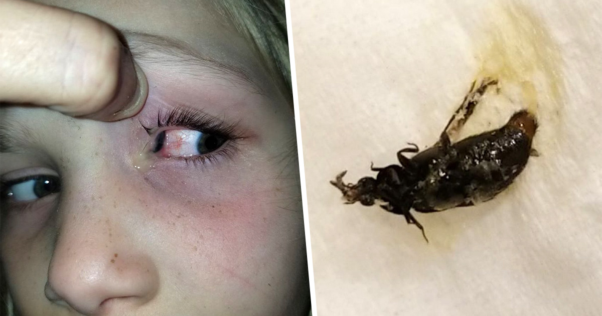 Une mère découvre un coléoptère géant rampant dans la tête de sa fille
