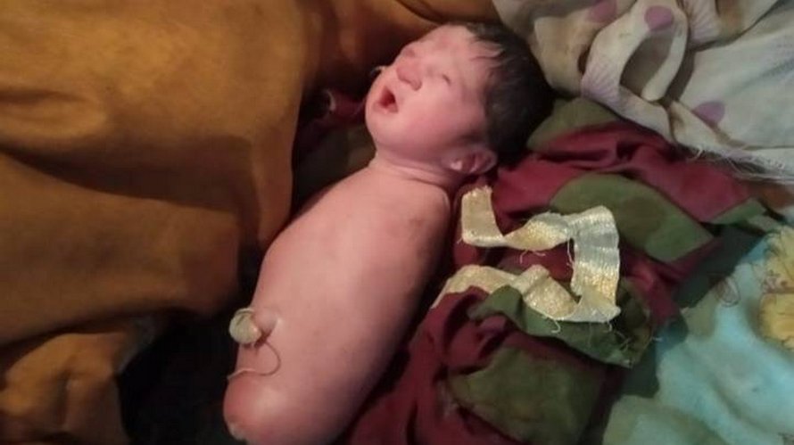 Un bébé est né sans bras ni jambes en Inde