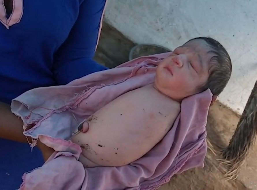 Un bébé est né sans bras ni jambes en Inde