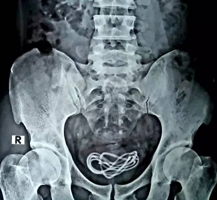 Un homme se retrouve avec un poisson entier coincé dans le rectum après s’être assis dessus « par hasard »