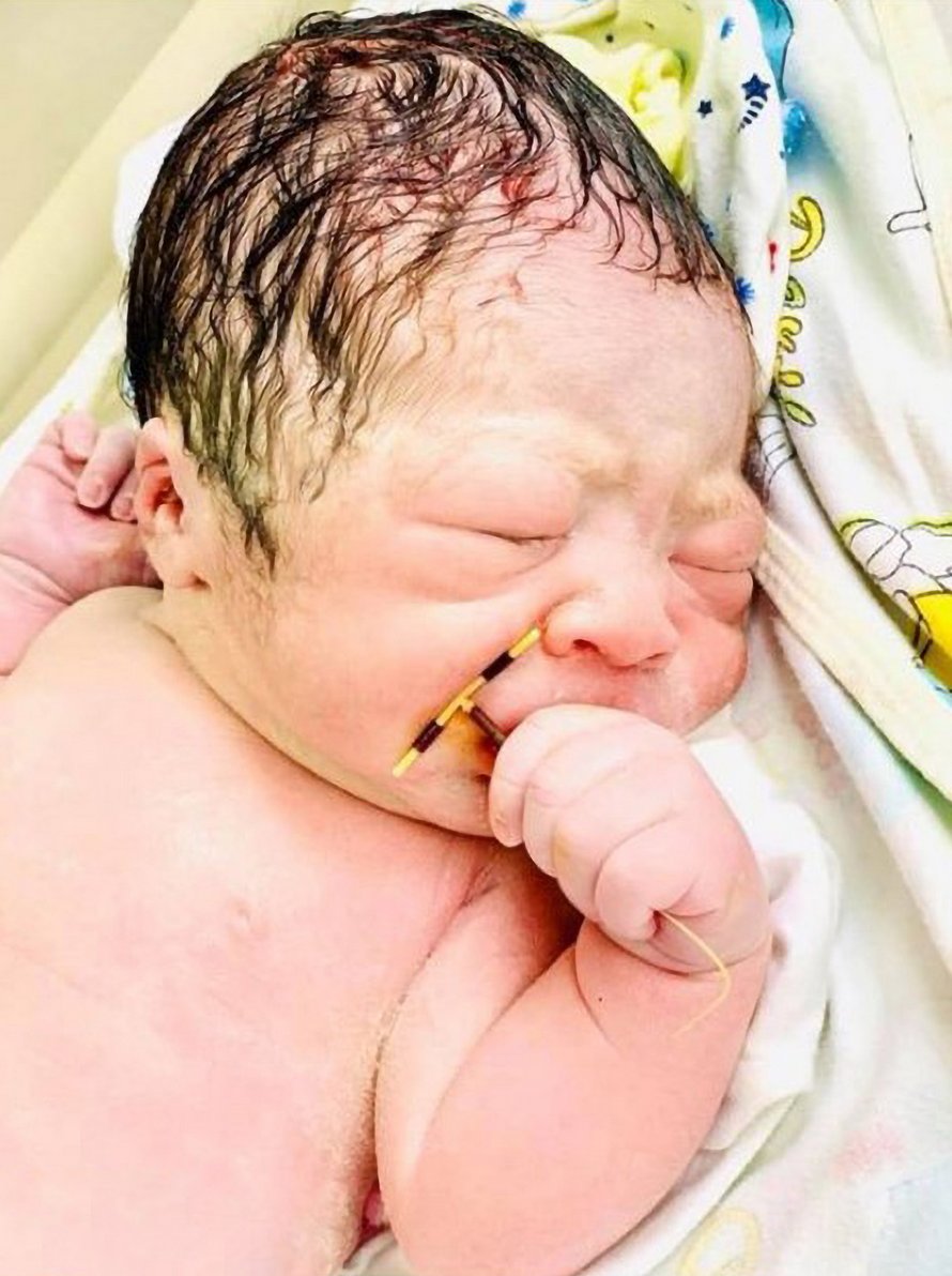 Un bébé nait avec le stérilet de sa mère dans la main et ses photos deviennent virales