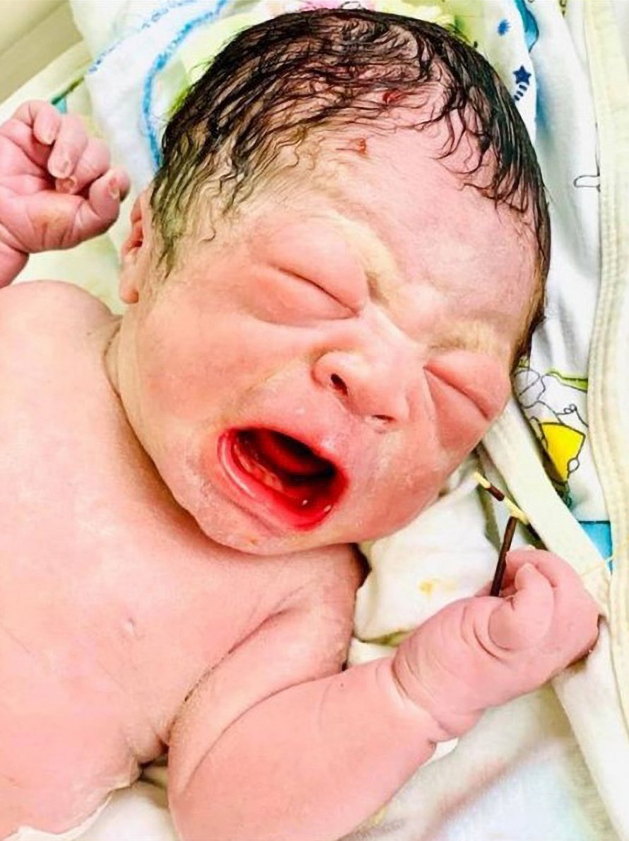 Un bébé nait avec le stérilet de sa mère dans la main et ses photos deviennent virales