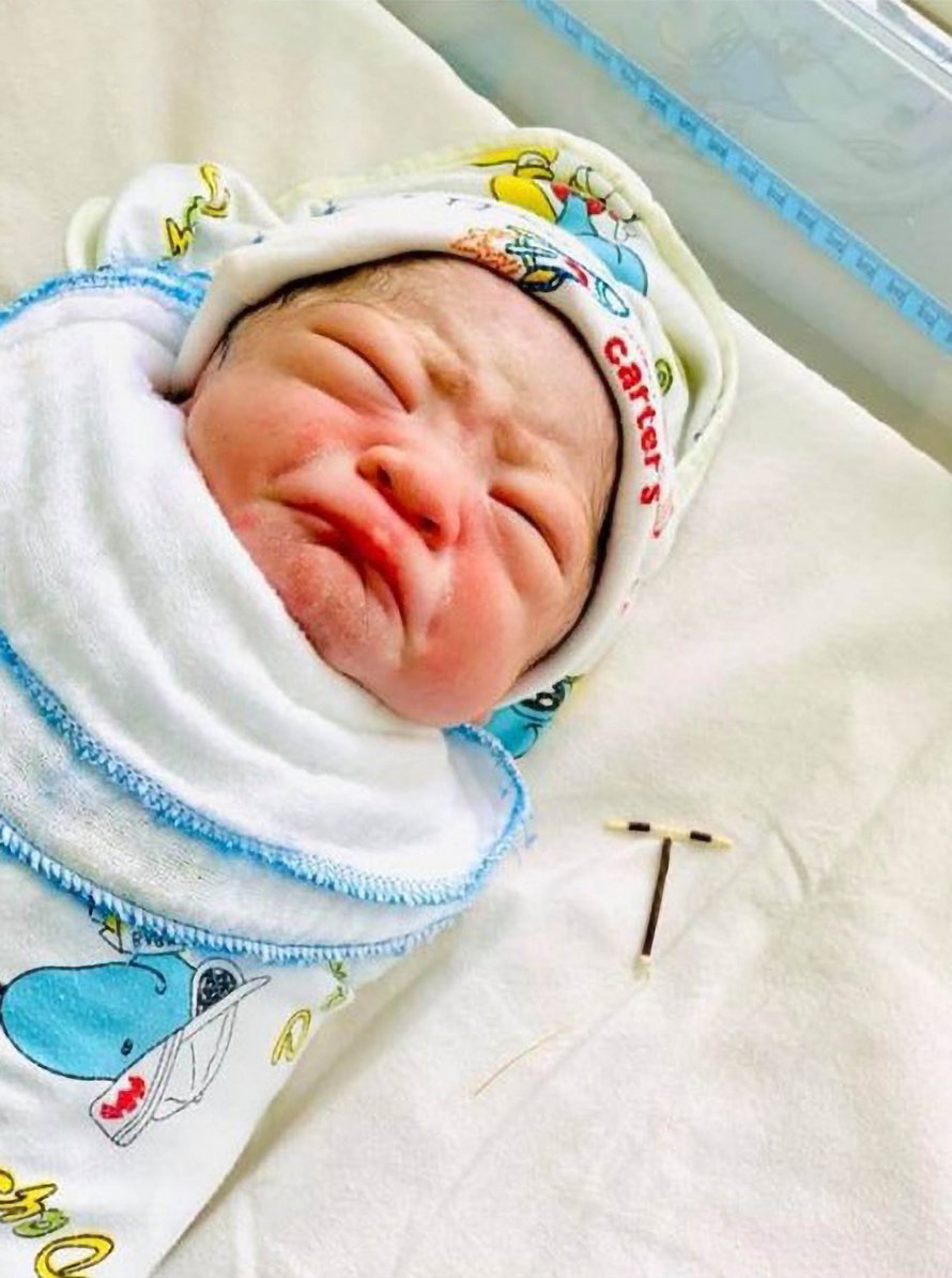 Un Bebe Nait Avec Le Sterilet De Sa Mere Dans La Main Et Ses Photos Deviennent Virales Ipnoze
