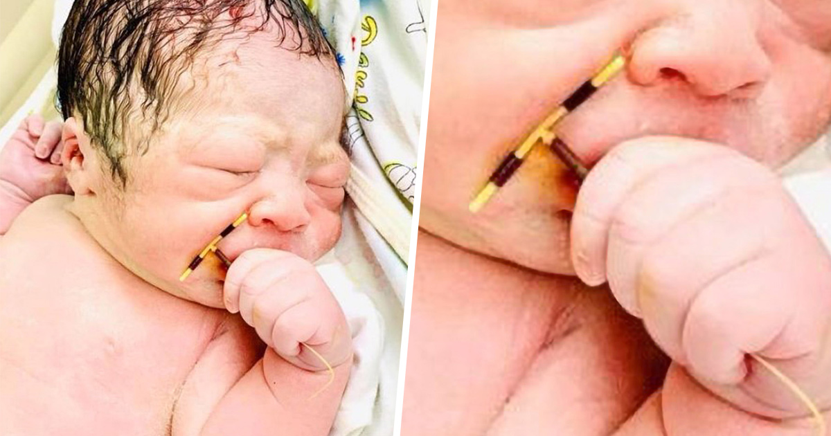 Un bébé nait avec le stérilet de sa mère dans la main et ses