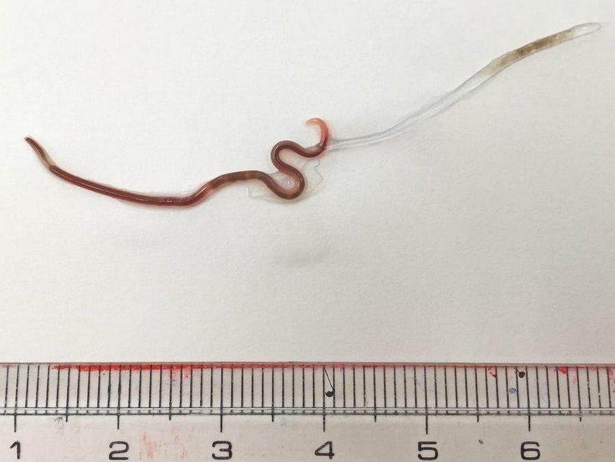 Des médecins ont trouvé un ver vivant dans la gorge d’une femme après qu’elle a mangé des sushis