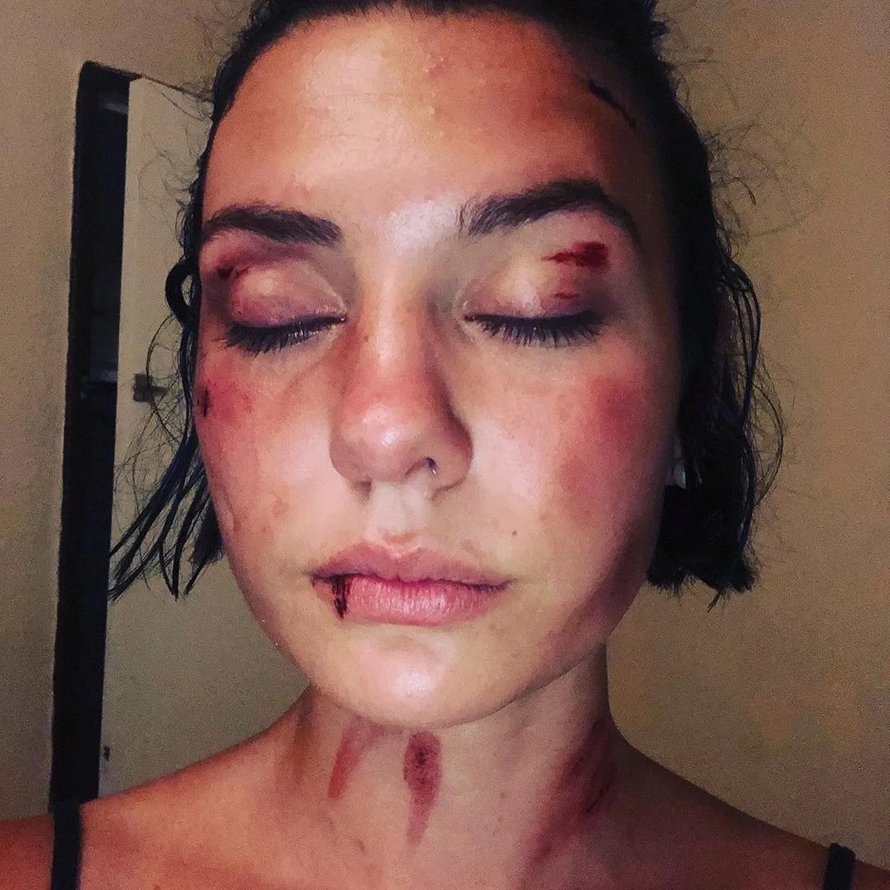Une jeune femme violemment agressée par trois hommes à Nîmes publie une vidéo percutante pour « ne plus avoir honte »