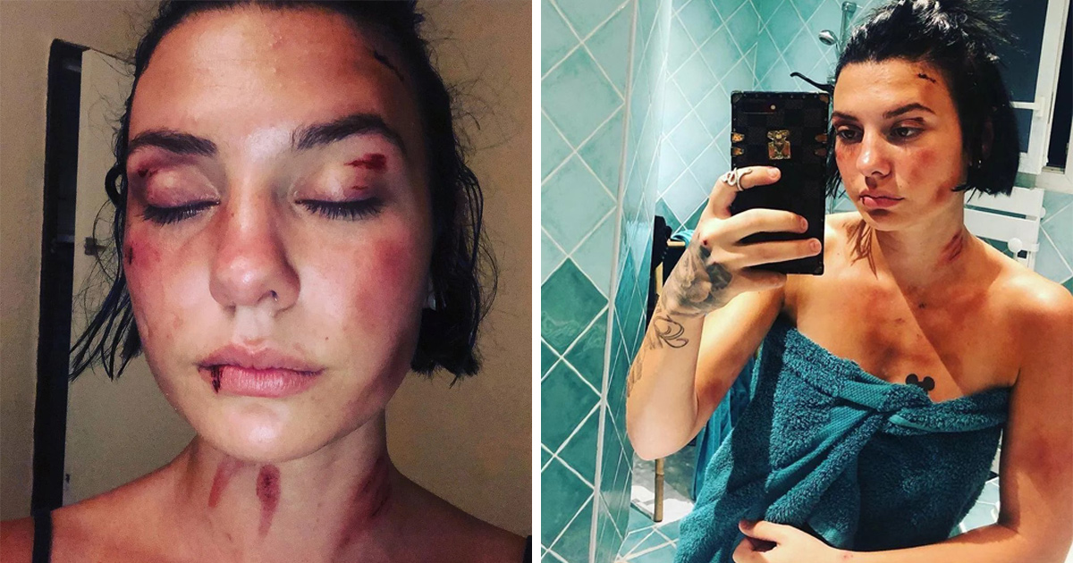 Une jeune femme violemment agressée par trois hommes à Nîmes publie une vidéo percutante pour « ne plus avoir honte »