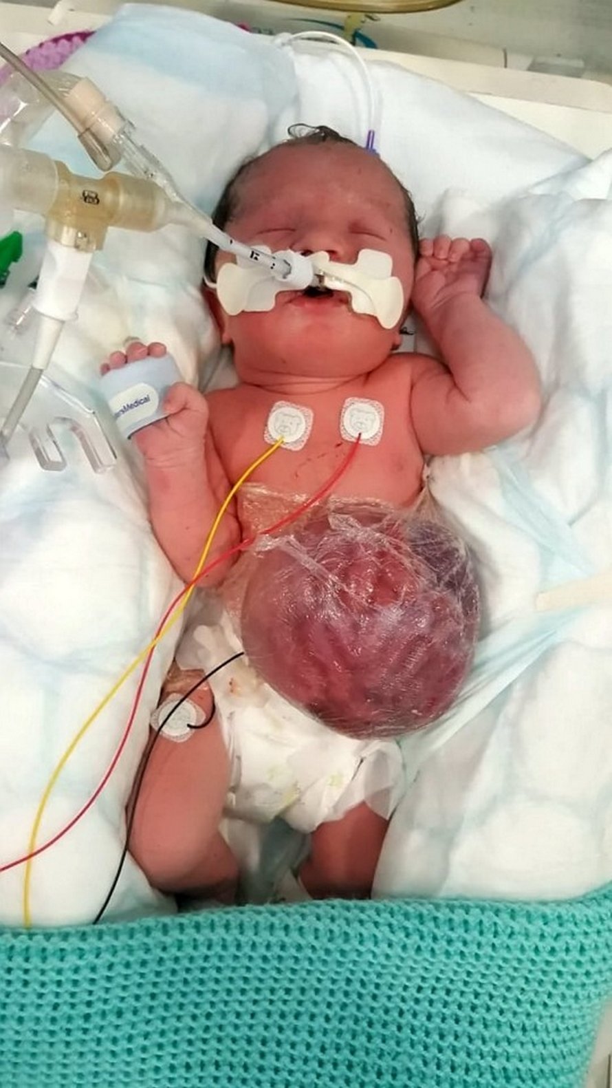 Cette petite fille est née avec les intestins, l’estomac et le foie à l’extérieur de son corps