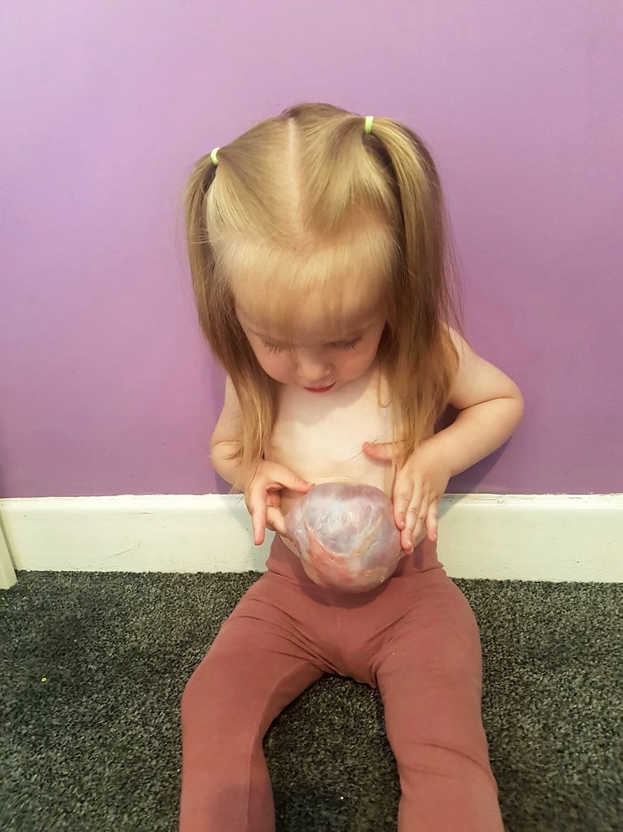 Cette petite fille est née avec les intestins, l’estomac et le foie à l’extérieur de son corps