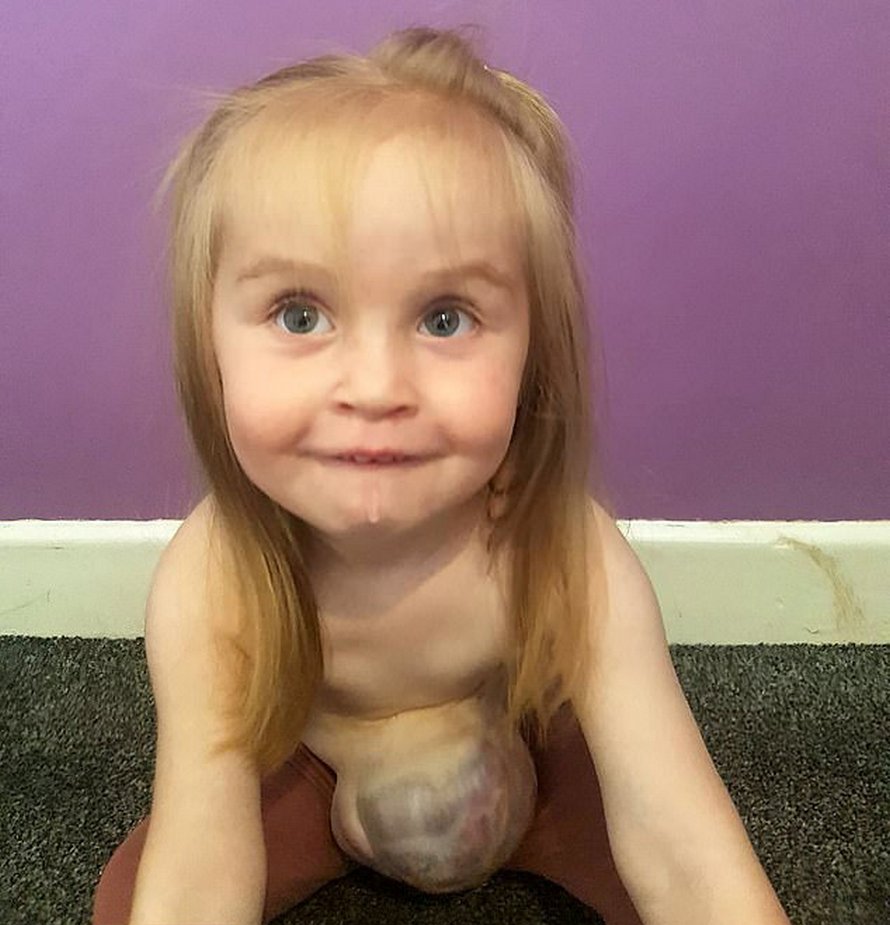 Cette petite fille est née avec les intestins, l’estomac et le foie à l’extérieur de son corps
