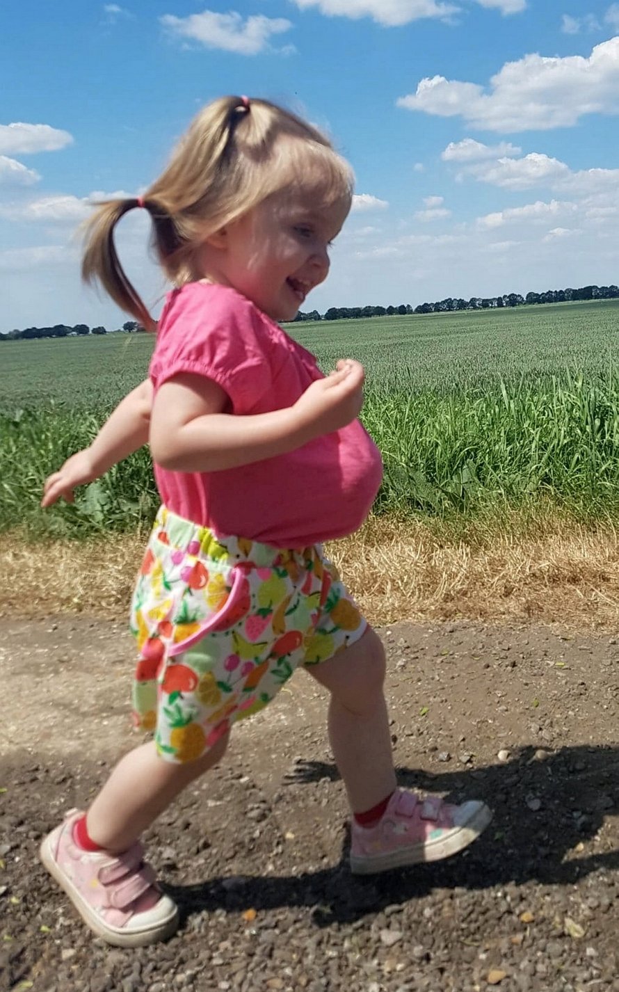 Cette petite fille est née avec les intestins, l’estomac et le foie à l’extérieur de son corps