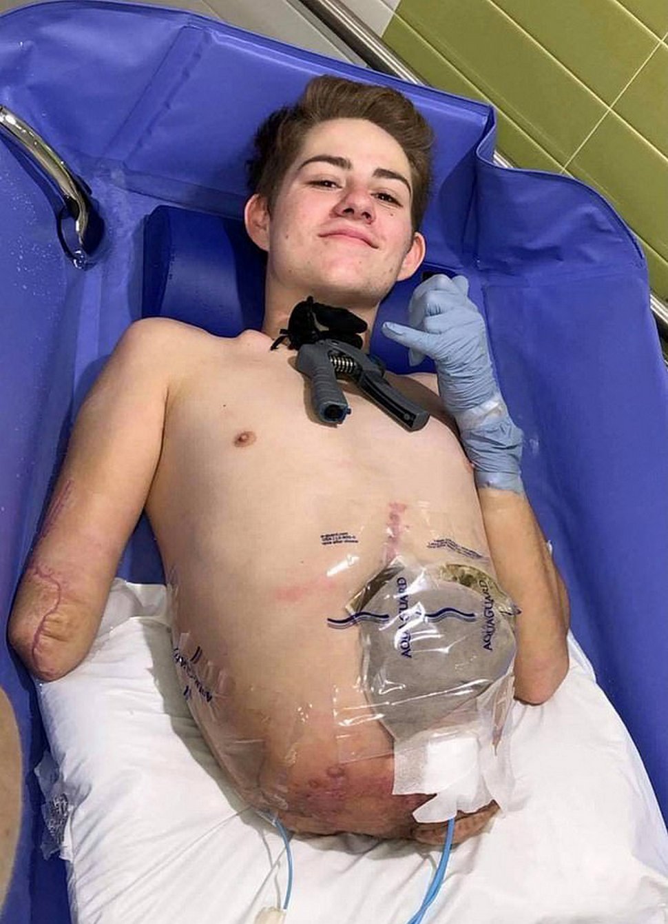 Un adolescent écrasé par un chariot élévateur choisit d’amputer la moitié inférieure de son corps pour sauver sa propre vie
