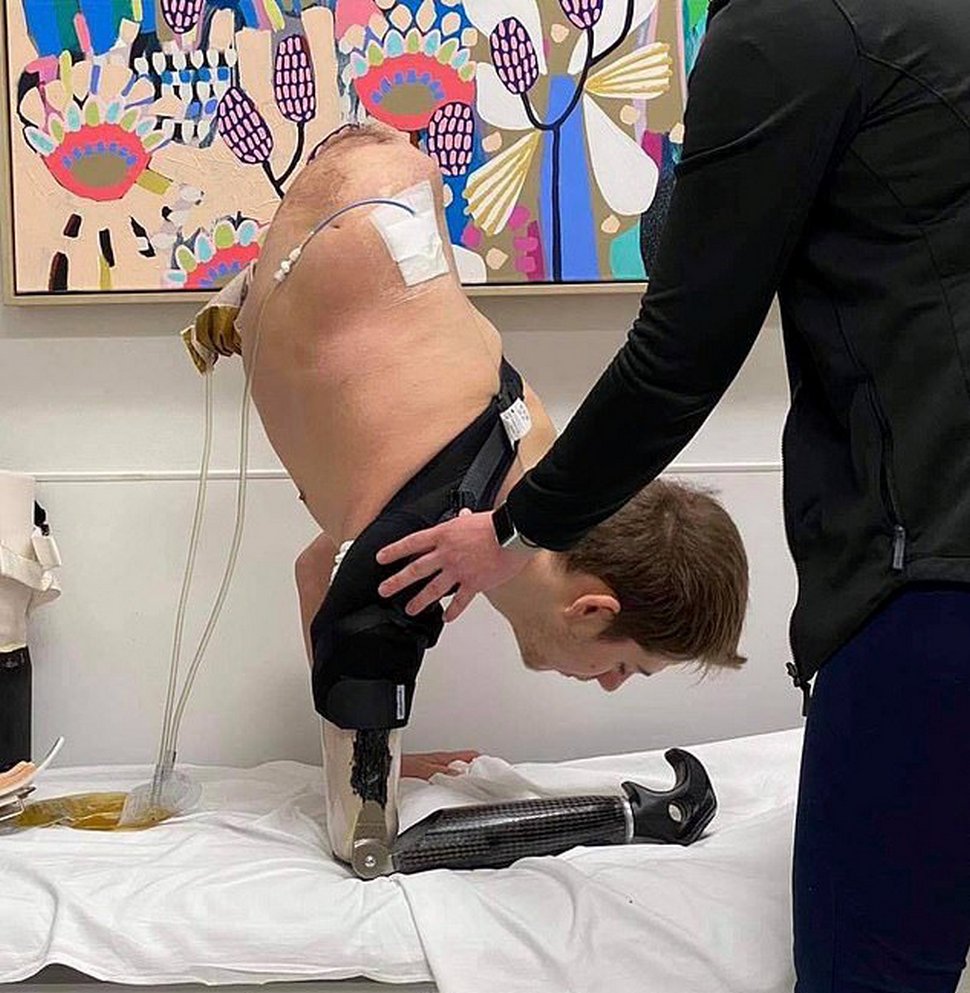 Un adolescent écrasé par un chariot élévateur choisit d’amputer la moitié inférieure de son corps pour sauver sa propre vie