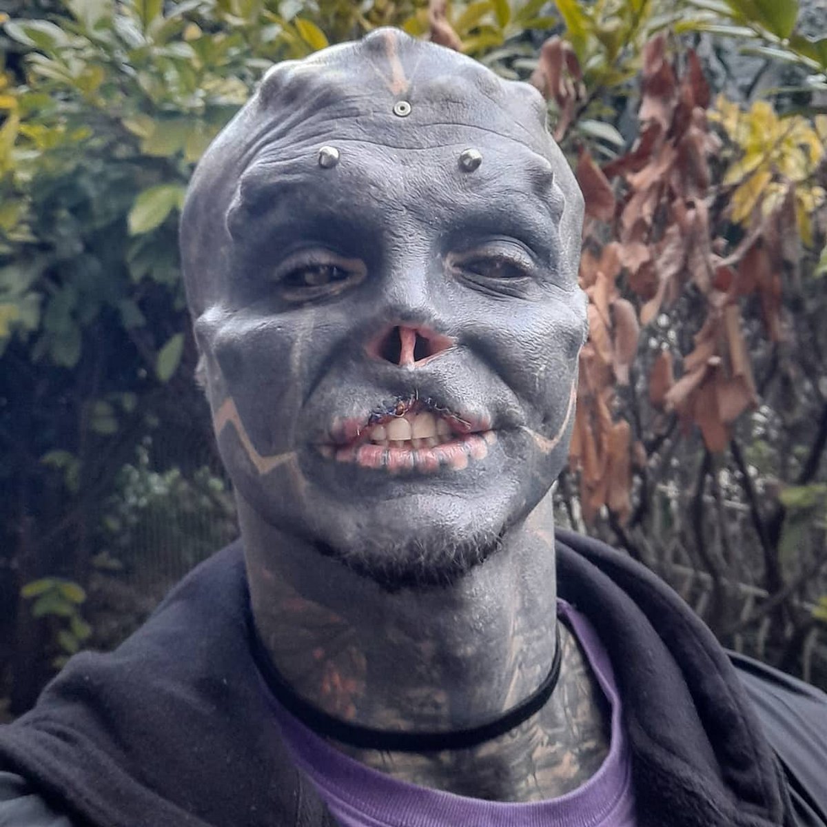 Cet homme sans nez qui s’est fait enlever la lèvre supérieure pour ressembler à un extraterrestre a maintenant du mal à parler