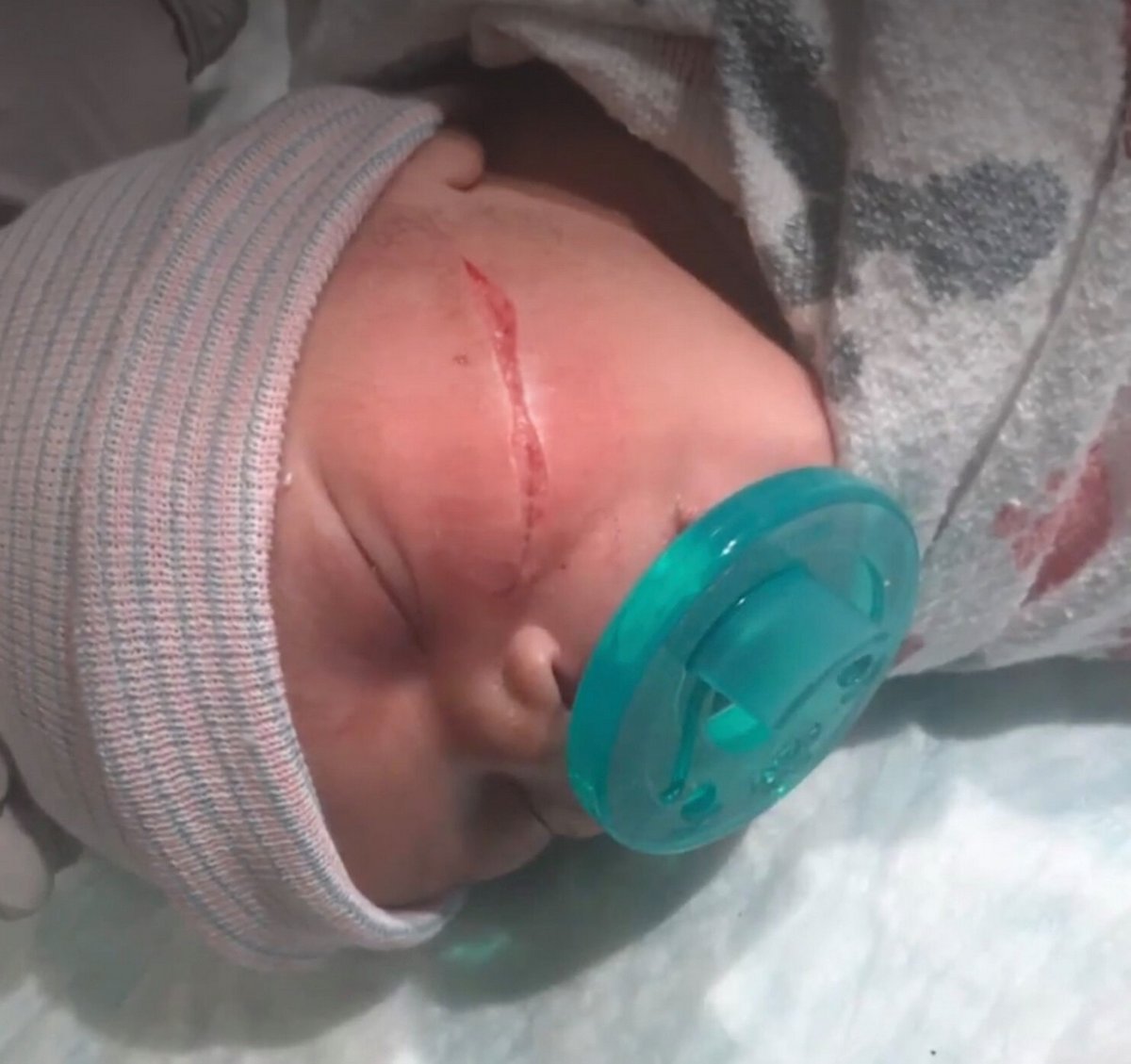Un bébé naît avec une énorme coupure sur le visage après une césarienne