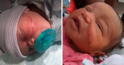 Un bébé naît avec une énorme coupure sur le visage après une césarienne