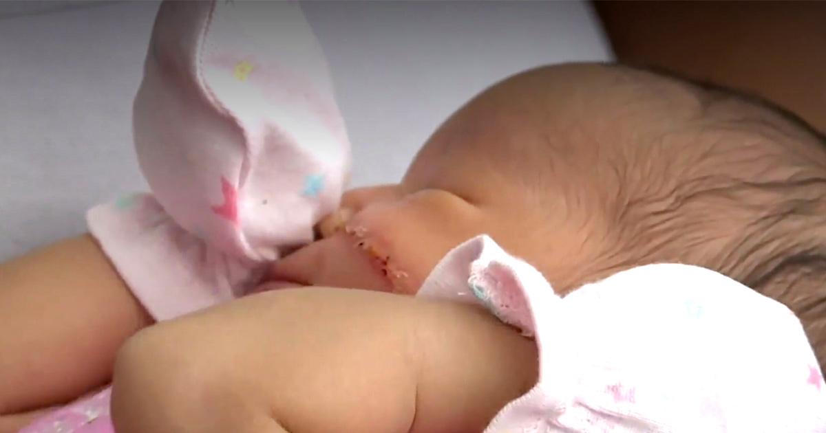 Un bébé naît avec une énorme coupure sur le visage après une césarienne
