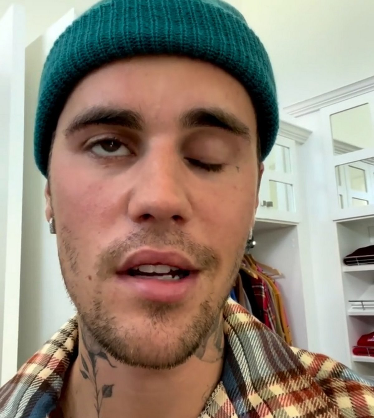 Justin Bieber est paralysé du visage et a de la « difficulté à manger »