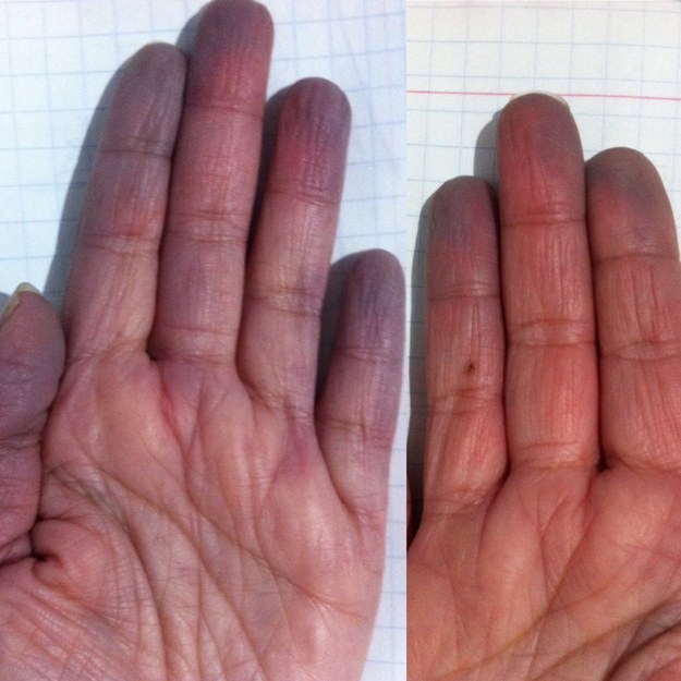 maladie-raynaud-froid-12